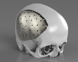 Titanium Alloy Skull Repair Plate